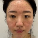 [🤍더마웰피부과의원] 리쥬란힐러, 텐써마 300샷 후기