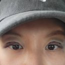 일치성형외과의원 | 겹쌍꺼풀 쌍꺼풀찝기 에픽성형외과 내돈내산후기