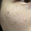 야리2길 | 양산 증산 기미 흑자 제거하는 &#34;아베르뷰티 색소지우개 멜라쥬 &#34; 일주일 리얼후기