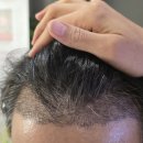 신상성형외과의원 | 강남 신사역성형외과 신상 절개 모발 이식 경과 후관리 찐 후기