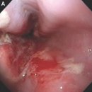 식도염(Esophagitis)동의어 : 급성 식도염,부식성 식도염﻿- 서울아산병원 소화기내과팀의 진단과 처방 예방법 이미지