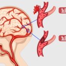 숨어 있는 뇌경색 찾아 내는 법 이미지