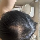 부산내과의원 | 탈모 약 처방 부산 자혜 내과 의원 실제 후기 리뷰