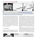 Mesenteric angiography를 이용한 hepatic tumor로의 portal perfusion에 대한 평가 이미지