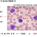 혈액암 중 림프종이란 무엇인가 ? 이미지