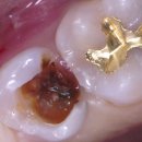 베토벤치과의원 | 시청역 치과의 충치가 심한 경우의 치료(심한충치 신경치료 후기)