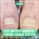전주 홀드펀칭 네일제작소 방문 후기 – 내성발톱과 무좀 고민 끝!