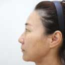 본디성형외과의원 | 40대 환자의 이마거상술, 눈밑거상술 실제 환자 1달 경과