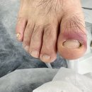 레푸스인하대역점 내성발톱 무좀발톱 발각질 문제성발 | 인천내성발톱 아빠랑 같이 다녀온 레푸스 인하대역점