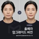 프라임성형외과의원 | 울쎄라 vs 울쎄라프라임 차이｜효과, 통증, 결과까지 비교 강남 훌륭 성형외과