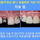 에이블치과기공소 네이버블로그