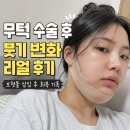 코부기수입 | 무턱수술 전후 붓기 관리, 한 달 차 라인 정리 후기