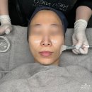 티에스메디칼 | [창원 아이블링] 4세대 "에어티에스" 물광관리 후기!