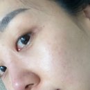 리참성형외과의원 | 리참성형외과 트리플프로, 동안피부관리 추천,스킨부스터 쥬베룩시술 받고 피부 맑아진 후기