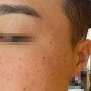 화곡역 피부과에서 루비레이저 받은 내 돈 내산 리얼 후기 (영수증 첨부)