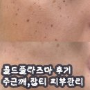 타임뷰티 | 콜드플라즈마 후기 통증 다운타임 뷰티온화 대구 피부관리
