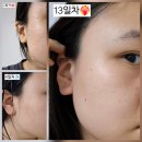 노원 서울편평사마귀성지 화접몽한의원 거우침으로 편사 제거 후기