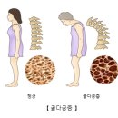 채홍일 카페-골다공증 예방에 좋은 음식과 골다공증에 나쁜 음식은?? 이미지