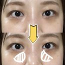 성옥빌딩(인자부동산) | [신논현역 피부과]눈밑꺼짐 cell주사 쥬베룩 볼륨과자가혈줄기세포주사로 다크서클없앤 후기