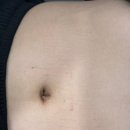 인천 맹장수술 비용｜명치통증으로 시작해 오른쪽 아랫배 통증으로 진행된 급성 충수염 사례