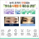 더문성형외과의원 | 망친 쌍수ㅠㅠ 더문성형외과 눈재수술로 다시 예뻐지기~
