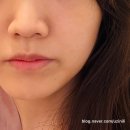 반포역 4번출구 뒤 | 서울 반포 피부/윤곽관리하기 좋은 미아체스킨앤바디 : 물방울 리프팅 비포 에프터 솔직후기