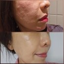 강남역성형외과 40대 리투오 더마샤인 붓기 엠보 효과 후기