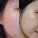 수원역광장 한의원 | 수원역 편평사마귀 제거 성지, 무제한레이저 가격 '후한의원 수원점'
