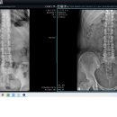 김지원환자 Lumbar 치료전후 이미지