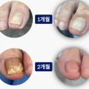 메디덴탈 솔루션 | 발톱이 건조해지고 발톱이 부스러지는 이유와 해결방법/발톱무좀치료제