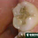 범플란트치과의원 네이버블로그