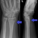 큐플린트 이미지