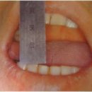 턱관절 장애 Temporomandibular joint disorders 이미지