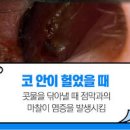 코안 헐었을때 연고 코안 염증 이유일까요 이미지