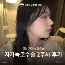 강남새약국 | 강남 자가늑코수술 기능코 2주차 내돈내산 후기 비용 통증 부작용 zip