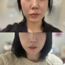 신촌셀프주유소 맞은편 | 티타늄 리프팅 내돈내산 후기 ෆ 얼굴선이 달라졌어요 ! (feat. 신촌 피부과)