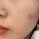 루체피부과의원 네이버블로그