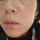 광천통뒤 - 좌 | 포텐자 펌핑팁 블룸쥬베룩 스킨부스터 2회차 내돈내산 후기