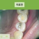 새빛치과기공소 | 마산치과추천 인레이 과정, 치료방법 꼭 필독하세요