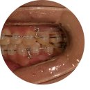 스마일라인치과교정과치과의원 | <대전교정전문치과> 성인 브라켓 재교정 후기
