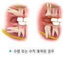 치아교정 - 사랑니와 교정치료, 매복된제3대구치 이미지