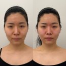 FINE FIT | 압구정 에스테틱 추천 다이아에스테틱 압구정점, 성형붓기관리 후기