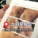 길케어 | [공지] [인천/부평] 부평 겨드랑이 색소침착 멜라닌케어 후기 '슈가문왁싱'