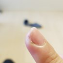 조갑주위염때문에 일산피부과 김영숙피부과 다녀왔어요