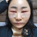 피자써클안면점 | 눈 밑 꺼짐 팔자 주름 이마주름 턱밑 처짐 다크서클 성형 3일차 붓기 최고
