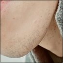 강남미의원 | 남성수염제모 솔직후기 강남역미의원에서 받고옴