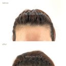 선헤어라인 이미지