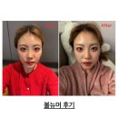 펄스코 | 한남동피부과 한남동 볼뉴머 효과 후기 흉터복원