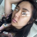 경대자연병원 | [대구 코필러/대구 필러 추천]경대병원피부과 자연스러운 코필러 솔직후기(버선코/민효린 코)