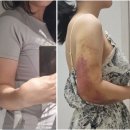 멍이랑몽이 미용 | 강동천호 팔뚝 지방추출주사 상담부터 당일 시술 후기